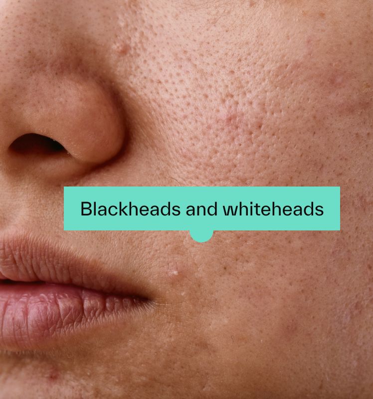 Blackheads and whiteheads
