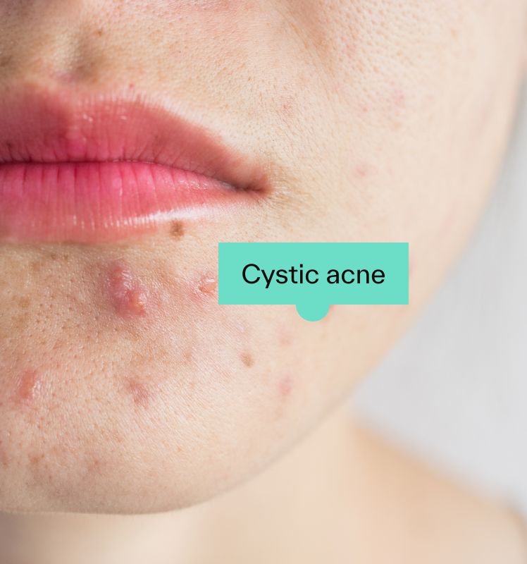 Cystic acne