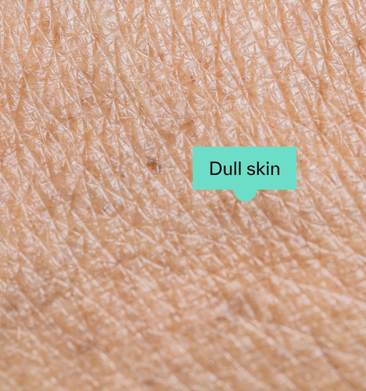 Dull skin