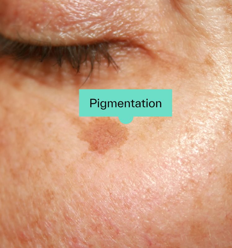 Pigmentation