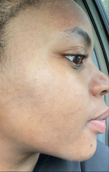 Dermatica - Deborah's after picture