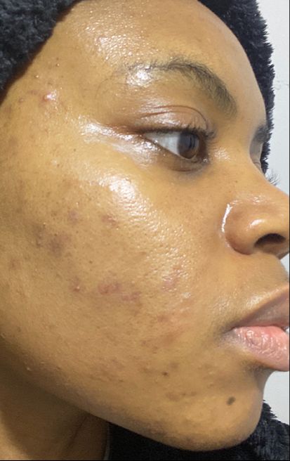Dermatica - Deborah's before picture