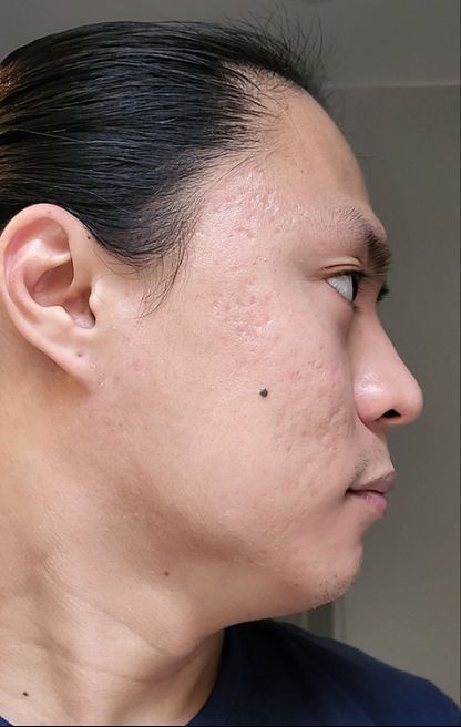 Dermatica - Paul's after picture