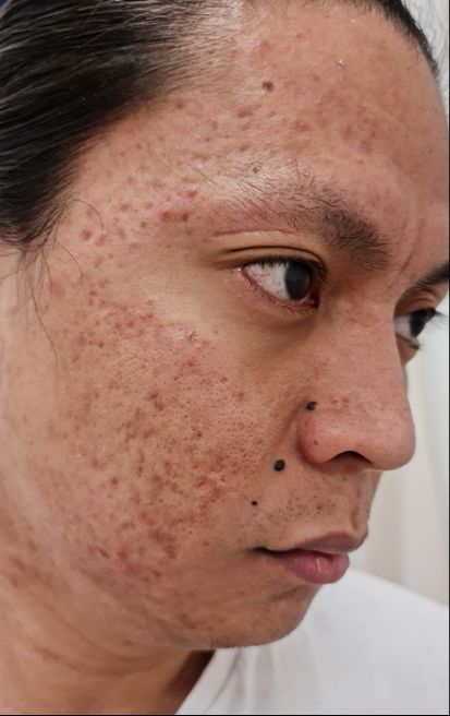 Dermatica - Paul's before picture