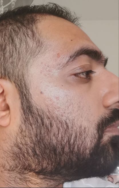 Dermatica - Umy's after picture