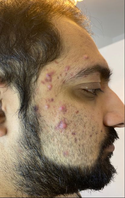 Dermatica - Umy's before picture