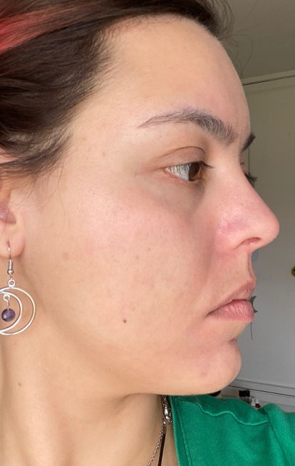 Dermatica - Nathalia's after picture