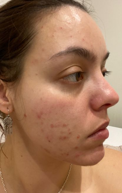 Dermatica - Nathalia's before picture