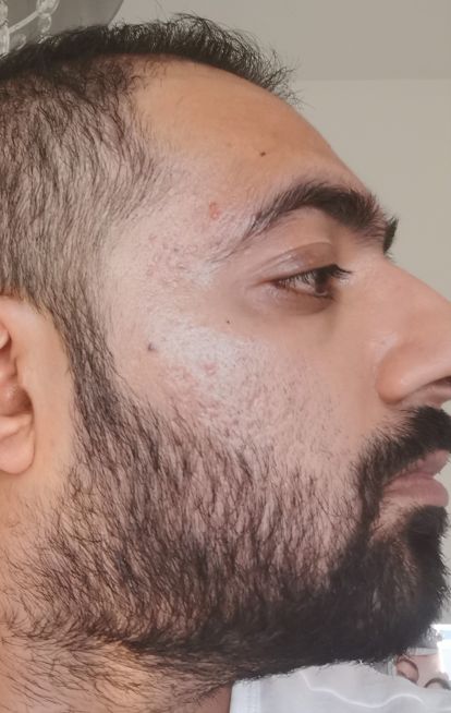 Dermatica - Umy's after picture