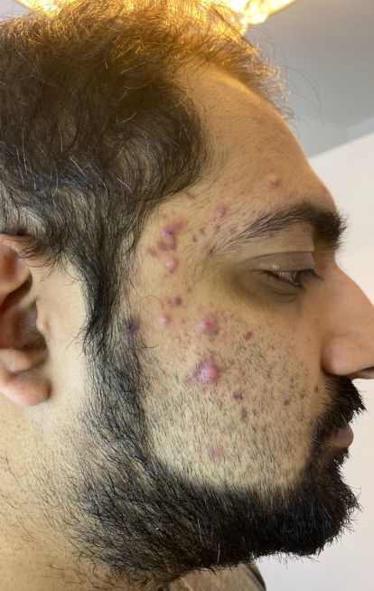 Dermatica - Umy's before picture