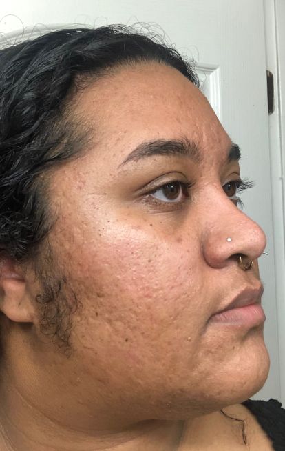 Dermatica - Deja's after picture