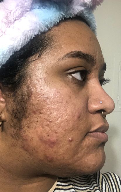 Dermatica - Deja's before picture