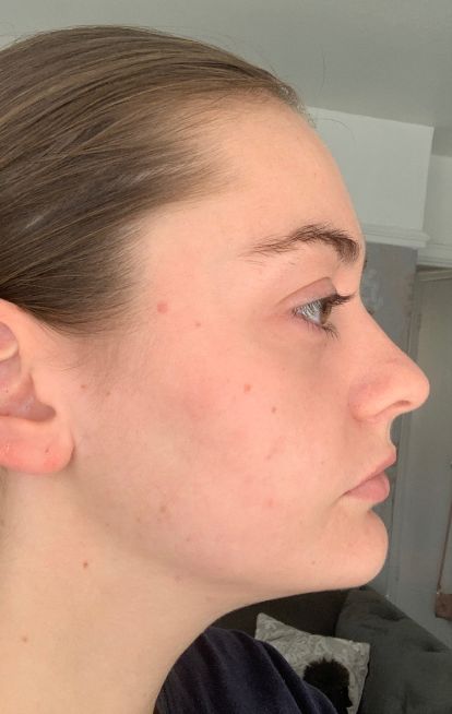 Dermatica - Rebecca's after picture