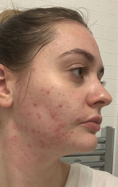 Dermatica - Rebecca's before picture