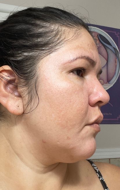 Dermatica - Karen's after picture