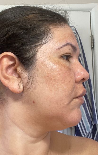 Dermatica - Karen's before picture