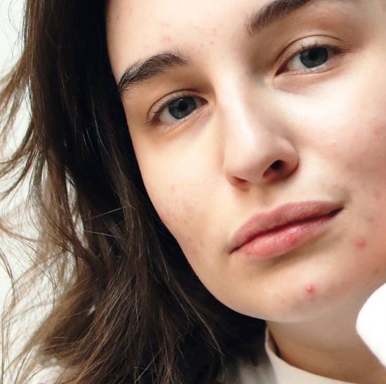 Woman face with some pimples