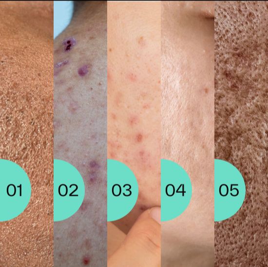 Things to know about acne scarring