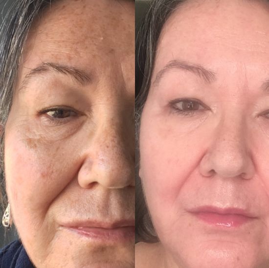 Melanie; before and after