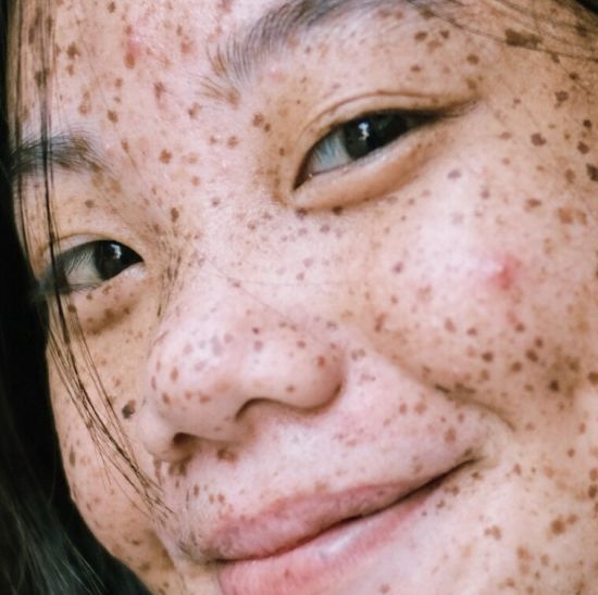 Woman with pigmentation