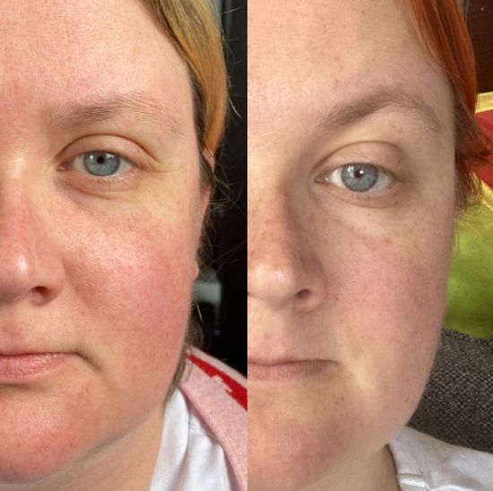 Alison before - after