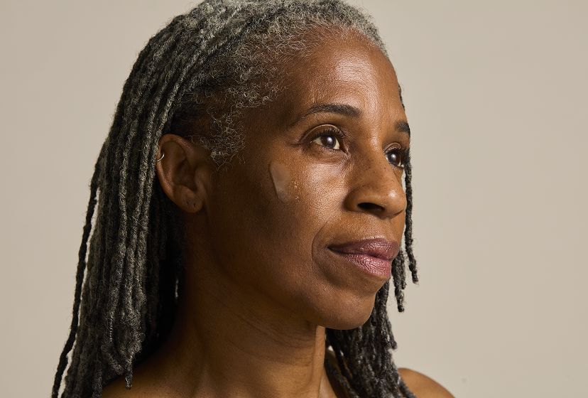 Dermatica customer applying Azelaic Acid