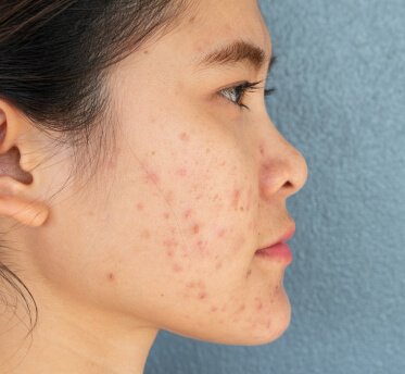 Face with hyperpigmentation