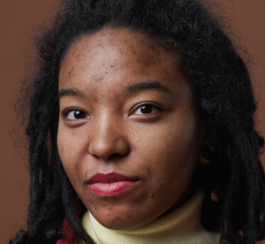 Pigmentation with acne face