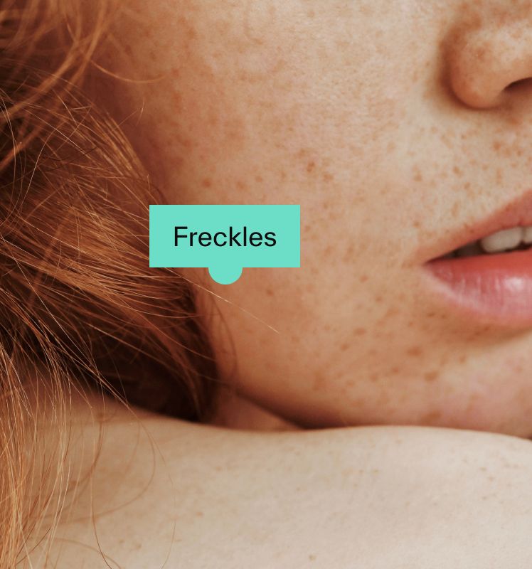 Freckles