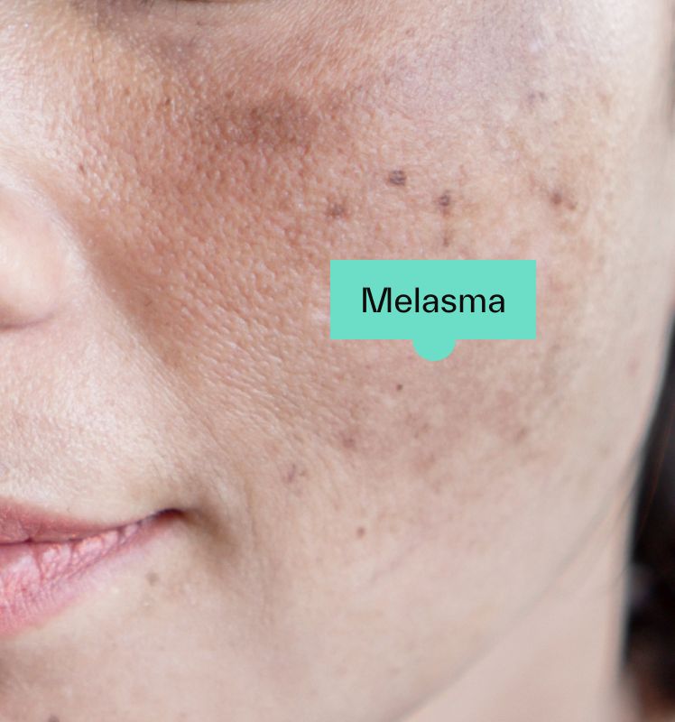Melasma