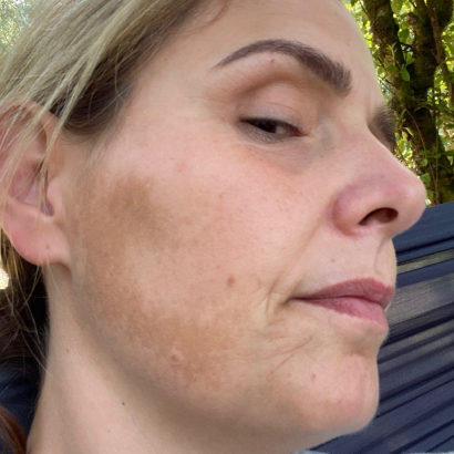 Dermatica - Before picture