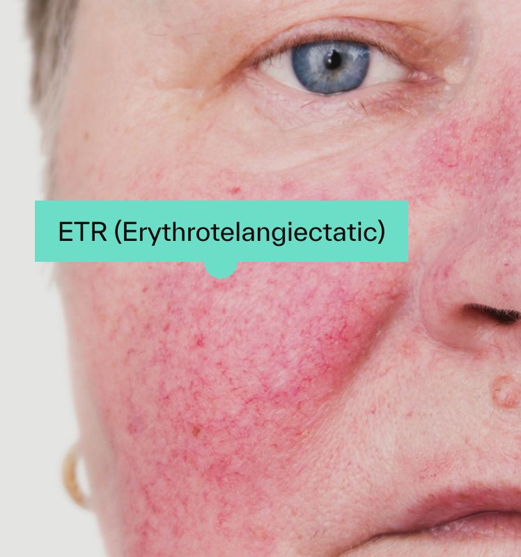 Erythematotelangiectatic Rosacea