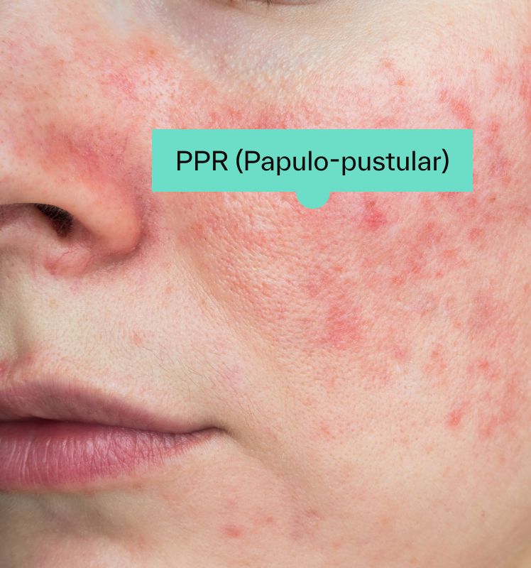 Papulopustular Rosacea