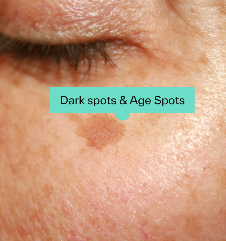 Dark spots